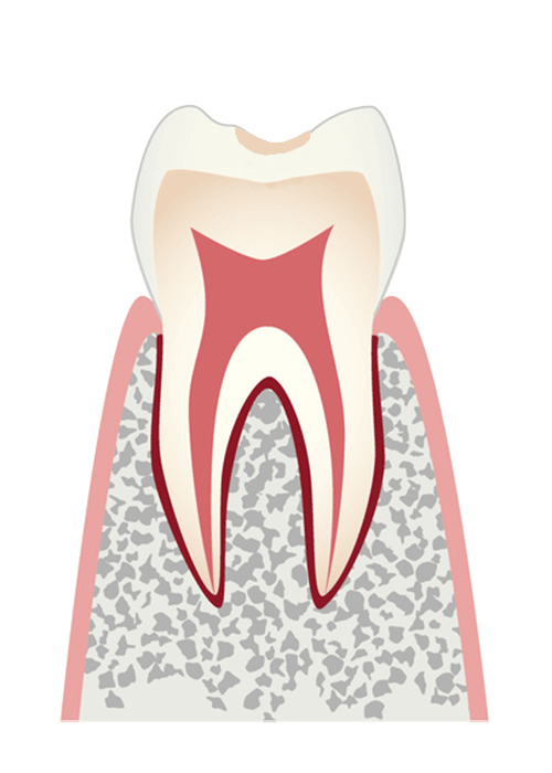 虫歯の進行CO