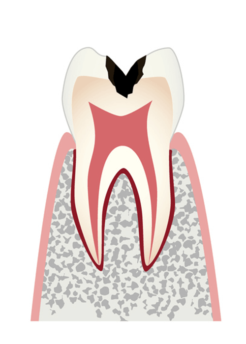 虫歯の進行C2