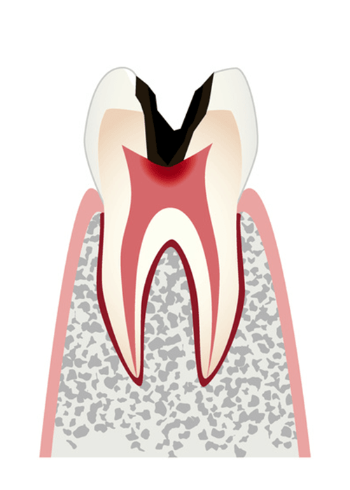 虫歯の進行C3