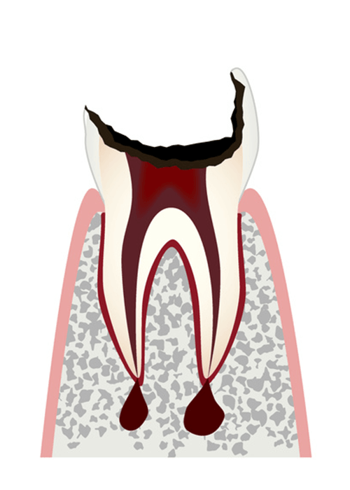 虫歯の進行C4